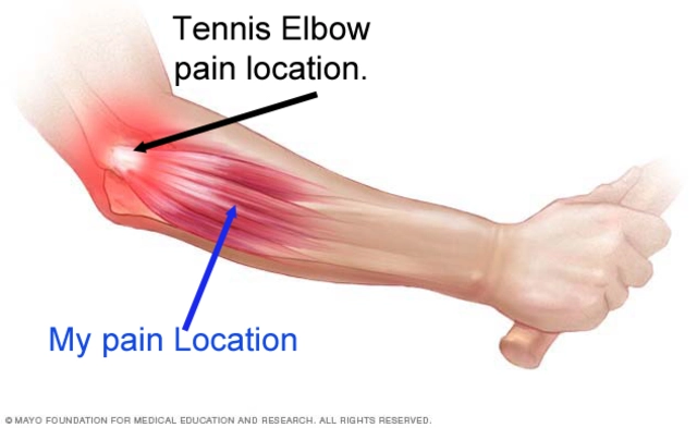 New information on tennis elbow and elbow pain.?
